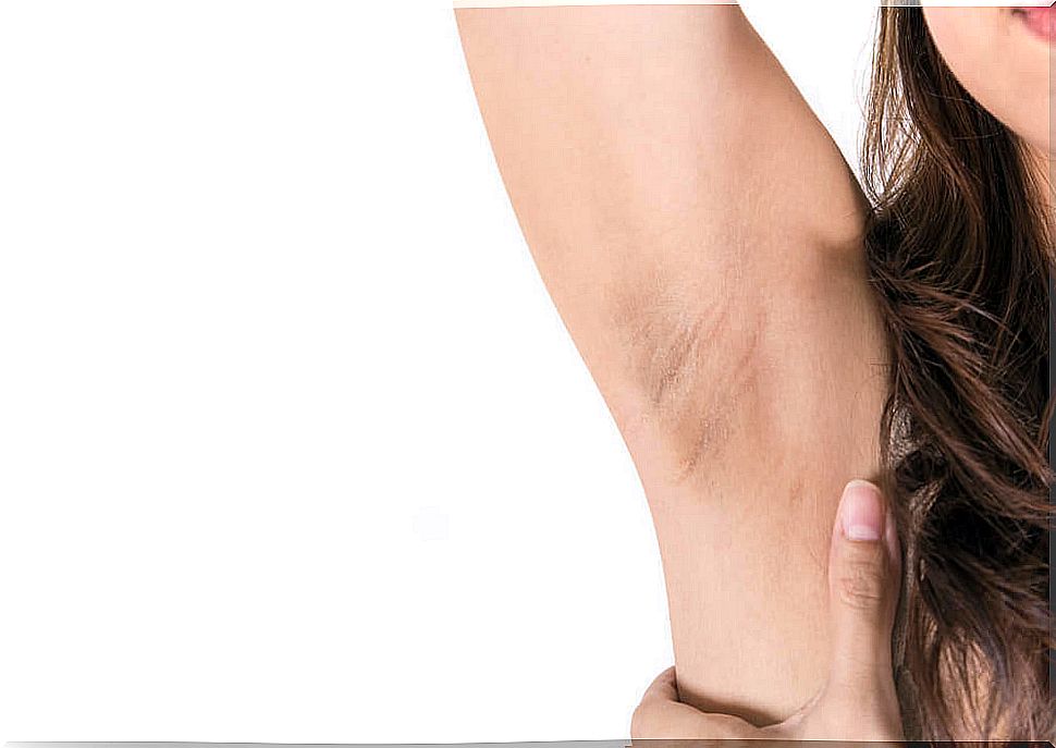 Underarm discoloration - lighten it with home remedies