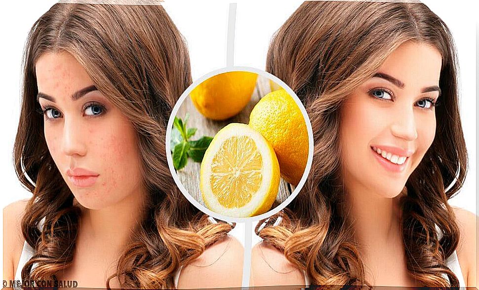 Acne scars - 4 natural home remedies to eliminate them