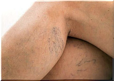 Varicose veins