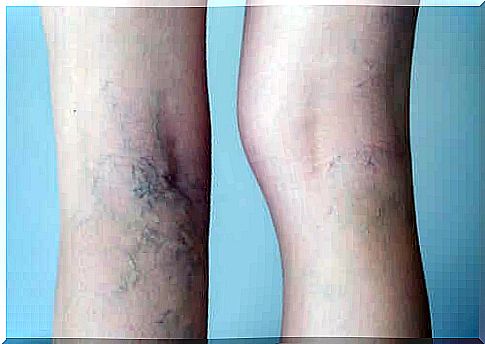 Varicose veins on the legs