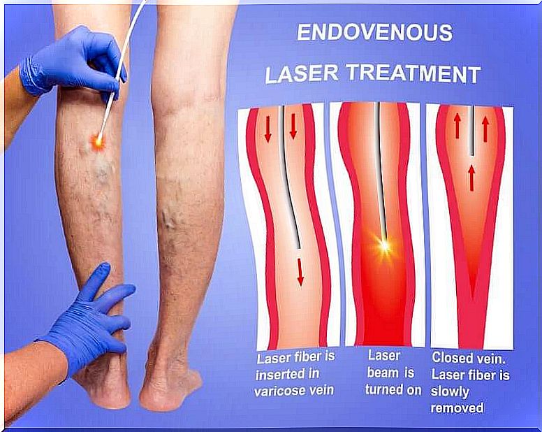 daflon and sclerotherapy