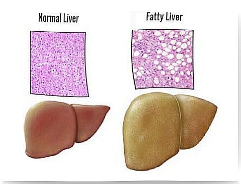 Fatty liver - foods to avoid