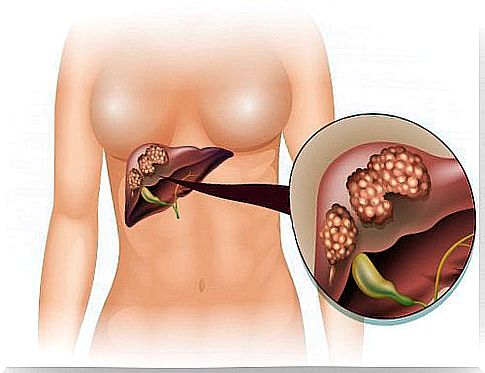 Fatty liver - 6 symptoms that cannot be ignored