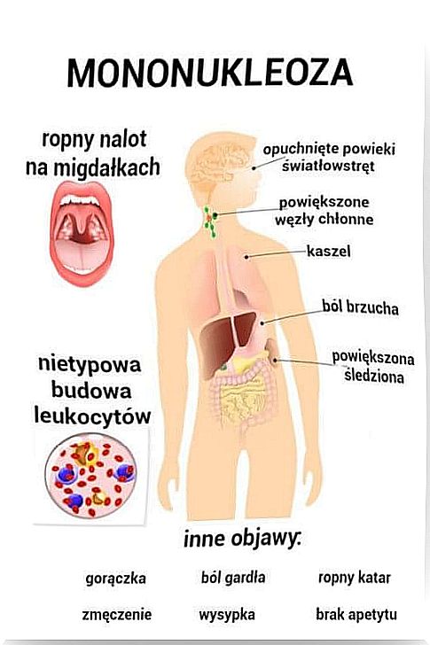 Mononucleosis