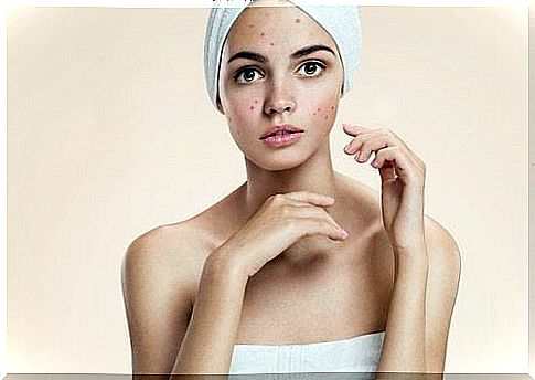 Woman with acne on her face