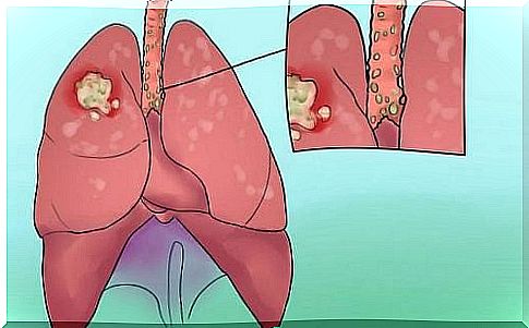 Lung cancer symptoms - don't underestimate them!