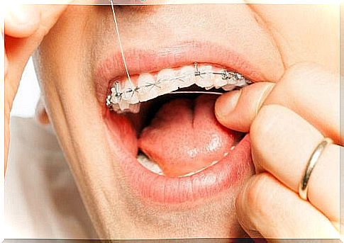 Oral hygiene with orthodontics - threads