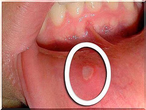 Mouth ulcer