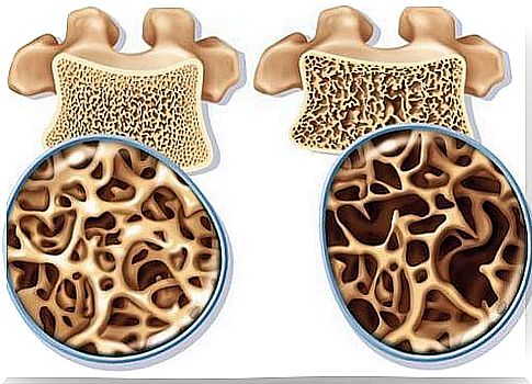 Osteoporosis - exercise and treatment