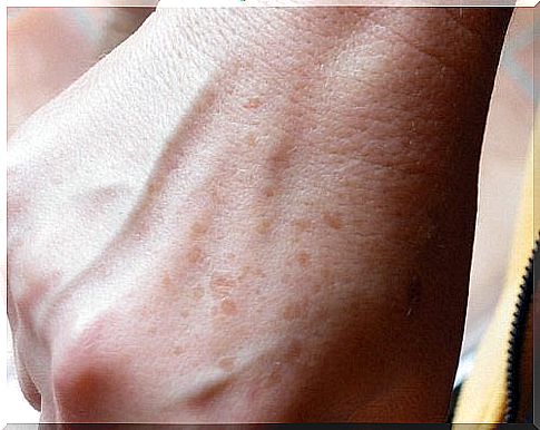 Spots on the skin?  Remove them naturally!