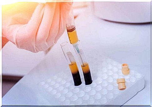 Thrombocytopenia in the laboratory