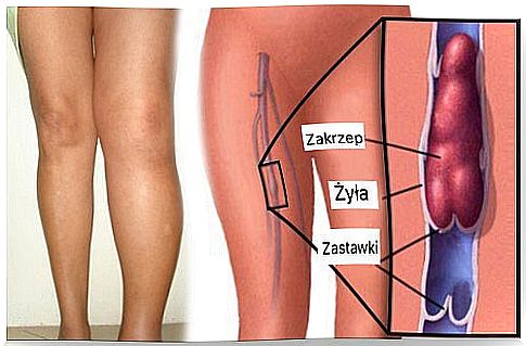 Venous thrombosis - how to avoid it?