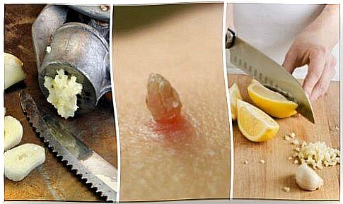 Warts - Get rid of them with garlic and lemon